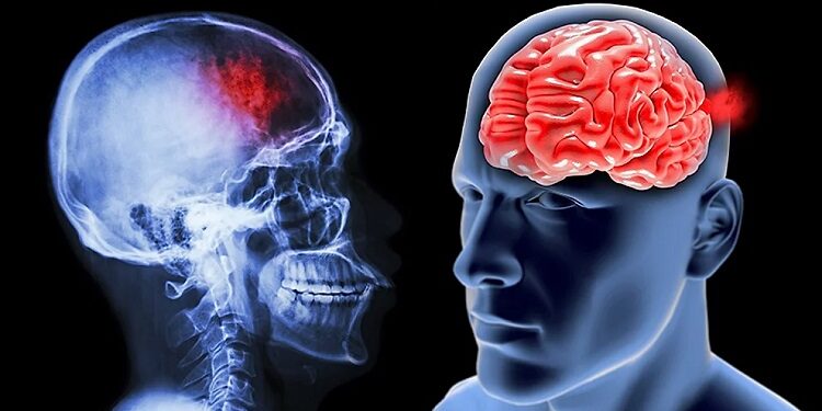 Consumul de grăsimi vegetale scade riscul de accident vascular cerebral